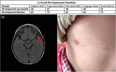 Novel Compound Heterozygous Variants of ETHE1 Causing Ethylmalonic Encephalopathy in a Chinese Patient: A Case Report